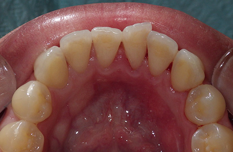 After Prophy Cleaning