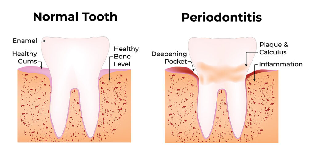 Chart illustrating a normal tooth compared to one with periodontitis. Periodontitis tooth showing deepening pocket, plaque and calculus and inflammation